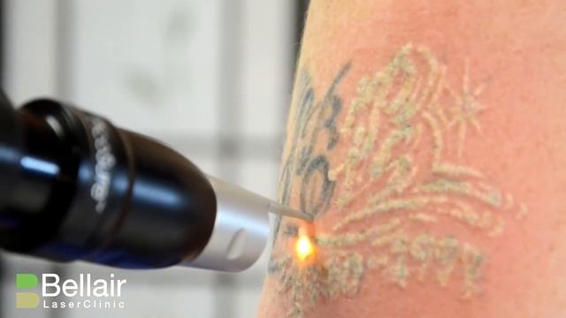 How does Picosure tattoo removal work? смотреть онлайн