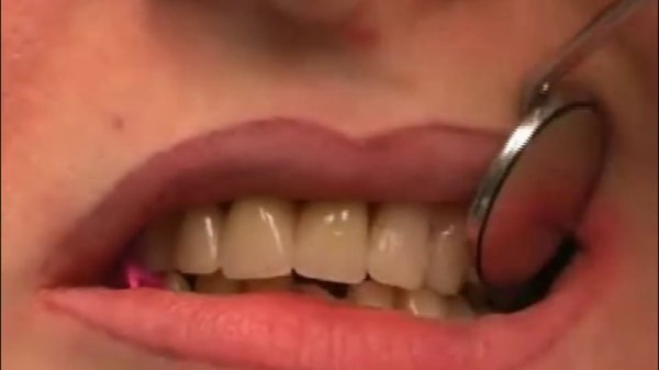 Что такое виниры?