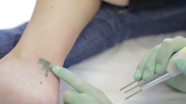 Laser Tattoo Removal Portland Oregon | Cascade Tattoo Removal смотреть онлайн