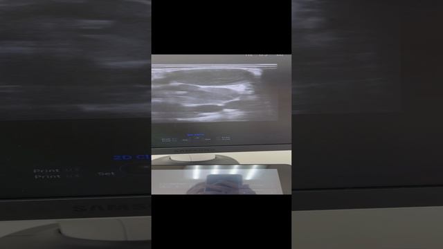 Массивный варикоз у парня. Узи сосудов. Сосудистый хирург. Флеболог Москва смотреть онлайн