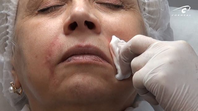 Обучение контурной пластике. С анастезией работаем вслепую. смотреть онлайн