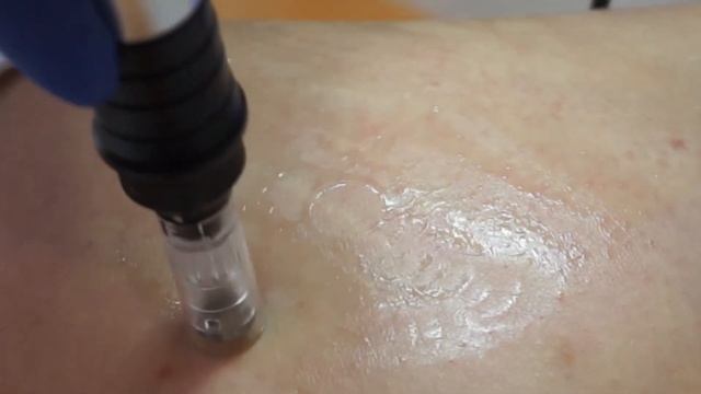 Фракционная мезотерапия