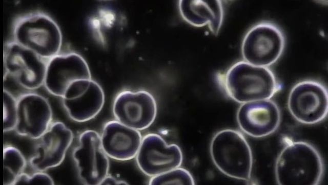 LIVE BLOOD ANALYSIS: RED BLOOD CELLS (TARGET CELLS) смотреть онлайн