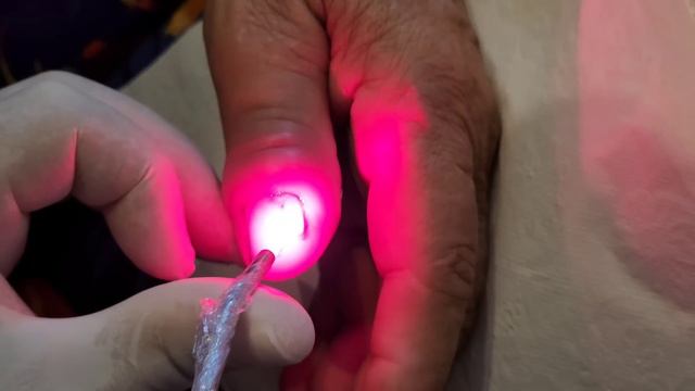 VOCÊ GOSTA DE PUS? ENTÃO VEM COMIGO #podologomaurelio #nails # смотреть онлайн