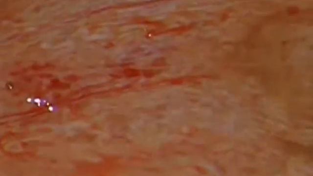 Микро Теза крипторхизм