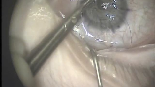 Cornea Transplant with Double Running Suture смотреть онлайн