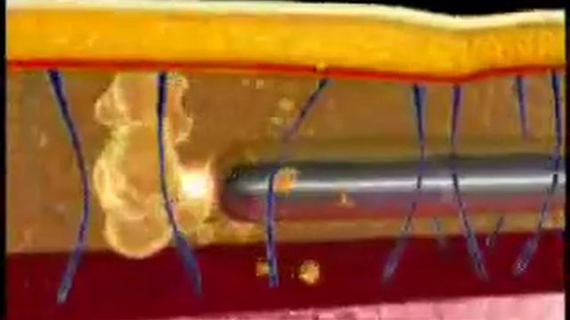 Laser FOTONA Lipoescultura 1 смотреть онлайн