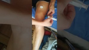 как откачать жидкость из колена в домашних условиях. Не повторять.