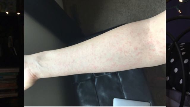 hell on earth: the lamictal rash (STORYTIME) смотреть онлайн