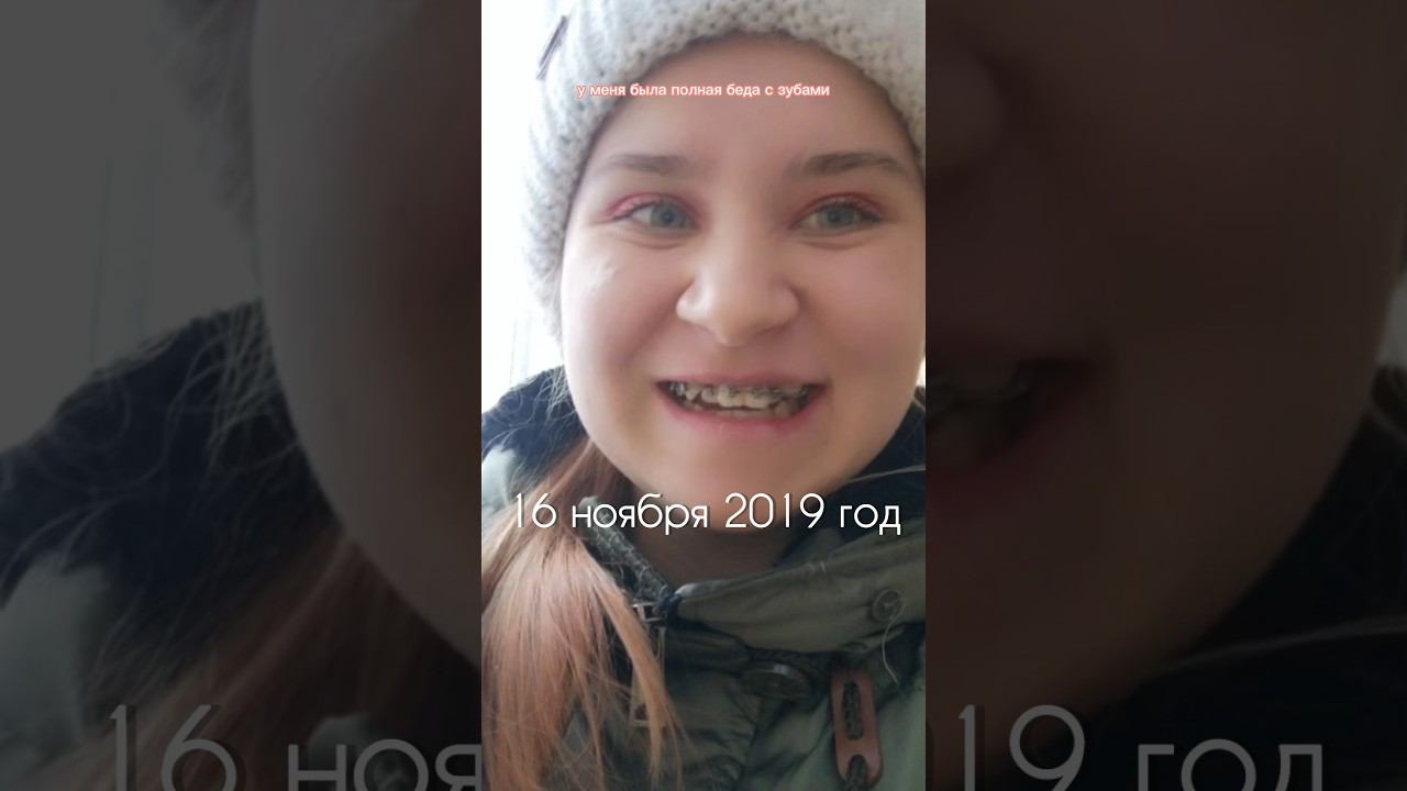 СТРАШНО ЛИ УСТАНАВЛИВАТЬ БРЕКЕТЫ? моя история ношения брекетов #брекеты #зубыдоипосле #зубы #влог смотреть онлайн