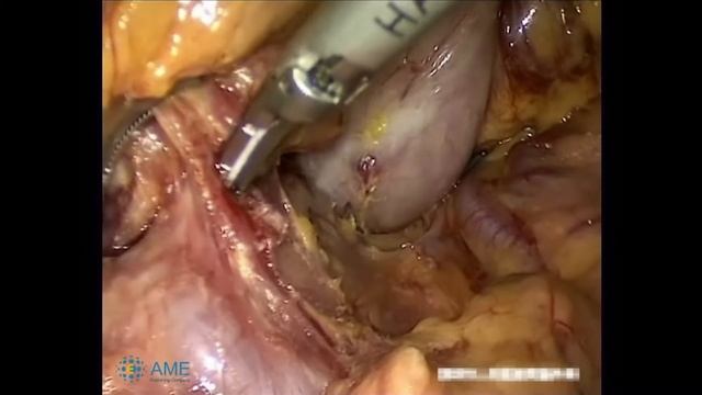 Asvide: Dissect the group 7, 8 and 9 lymph nodes смотреть онлайн