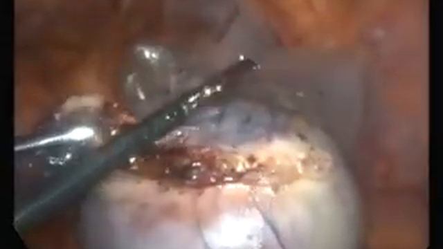 Twisted dermoid cystectomy Dr ashwini kalyankar. смотреть онлайн