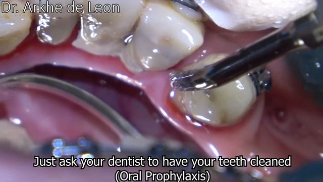 Tooth Cleaning w/ Ultrasonic Scaler (Oral Prophylaxis) 4K #C14 смотреть онлайн