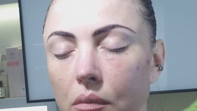 ПЕРИОРБИТАЛЬНАЯ область. Игла(фрагмент) смотреть онлайн