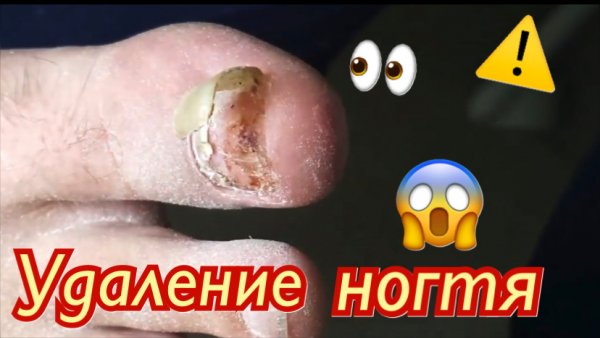 Удаление ногтя?⚠️????