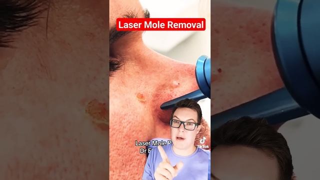 Dramatic LASER MOLE REMOVAL - Mole Removal Before And After #shorts