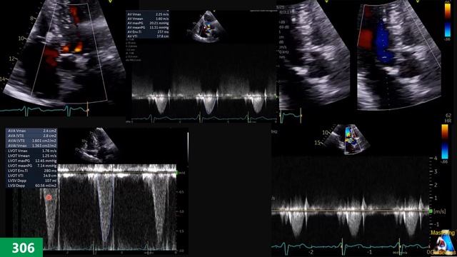 Hands-On Experience 23: HOCM Or Not? Valsalva Maneuver Technique