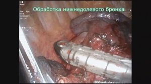 Торакоскопическая нижняя лобэктомия справа при раке легкого IIIA ст (РНЦХ им.акад.Б.В.Петровского)