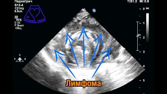 Медиастинальная лимфома и тампонада сердца у кошки смотреть онлайн