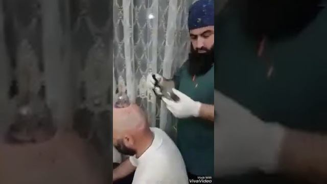 Хиджама на голову