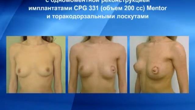 В.А. Соболевский: экспандеры при реконструктивной хирургии груди смотреть онлайн
