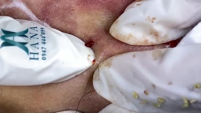 Big Cystic Acne Blackheads Extraction Blackheads & Milia, Whiteheads Removal Pimple Popping смотреть онлайн