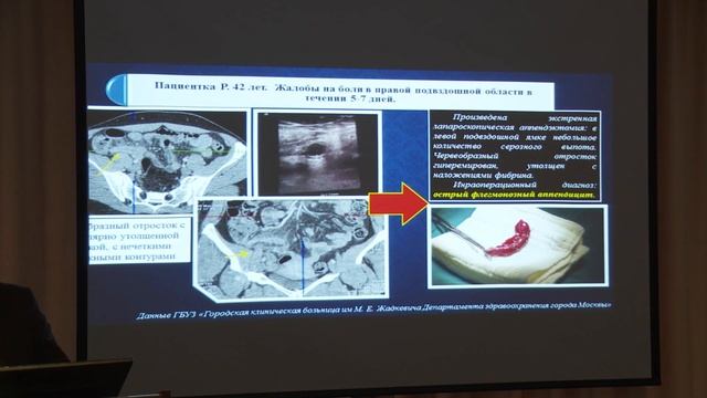 Нуднов Н.В. — Лучевая диагностика при синдроме «острый» живот смотреть онлайн
