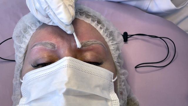 Лазерное удаление татуажа бровей. Мой опыт (вся процедура, заживление и советы) смотреть онлайн