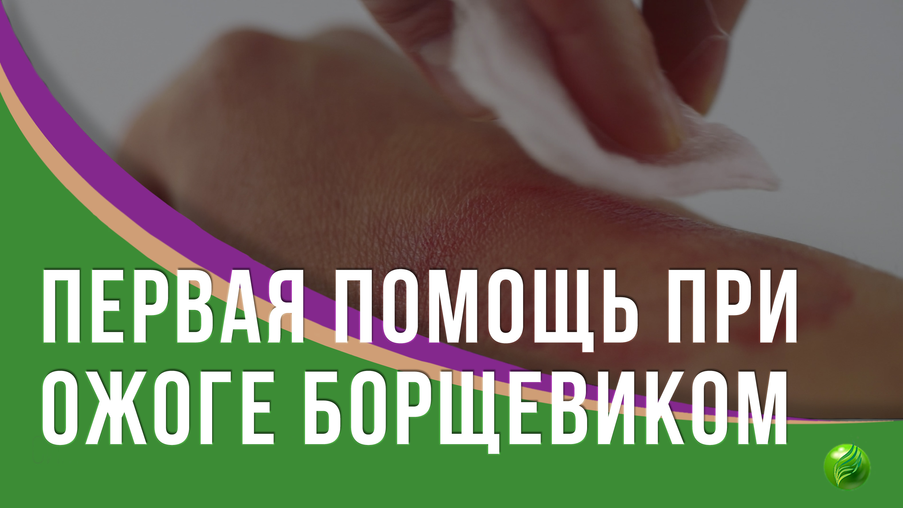 Первая помощь при ожоге борщевиком