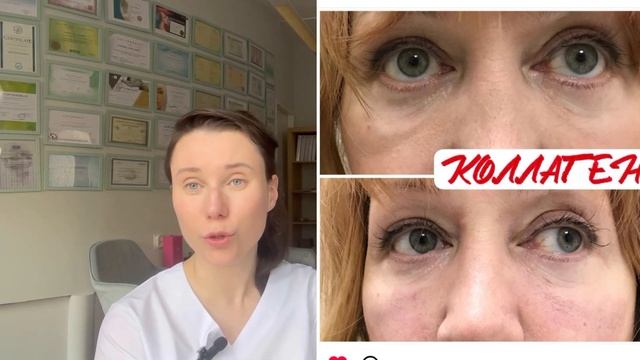 Сферогель или филлер? #носослезка #носослезнаяБорозда