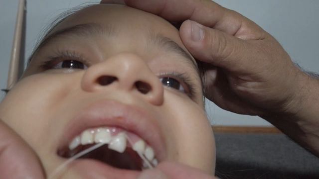 Como Quitar Diente De Leche Sin Dolor