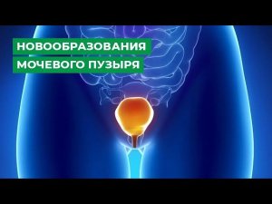 Новообразования мочевого пузыря