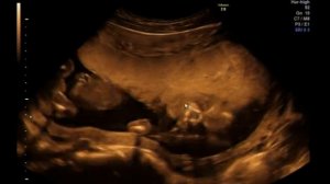 УЗИ в 18 недель / УРА мальчик!!!