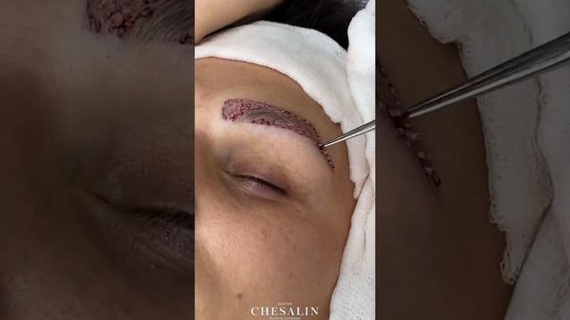 Пересадка бровей ! Трансплантация волос в зону бровей в процессе! До и сразу после! смотреть онлайн