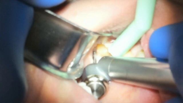Tutorial -- wisdom tooth extraction surgery. Impacted third molar смотреть онлайн