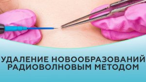 Удаление новообразований радиоволновым аппаратом типа Сургитрон