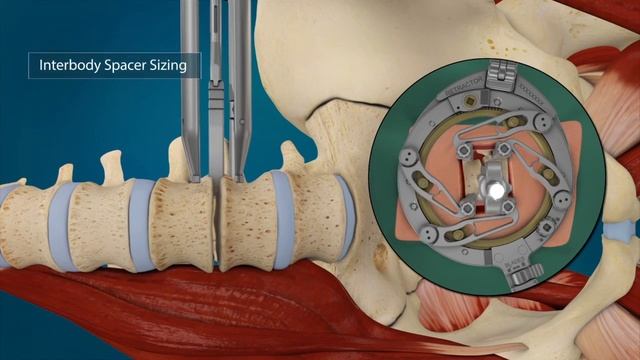 Orthofix: SKYHAWK Lateral Interbody Fusion System смотреть онлайн