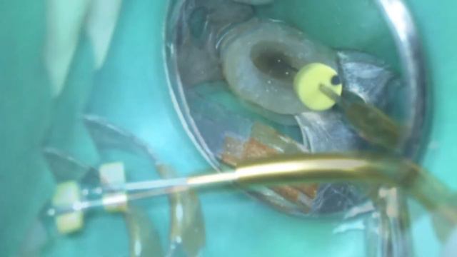 Широкий канал. Формирование апикального уступа и модификация мастер-штифта смотреть онлайн