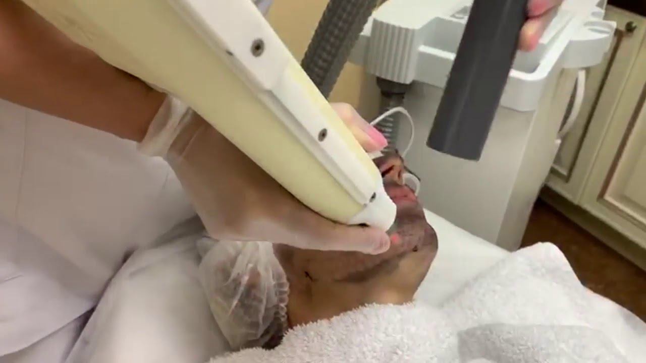 КАРБОНОВЫЙ ПИЛИНГ. Клиника "Градиент" смотреть онлайн