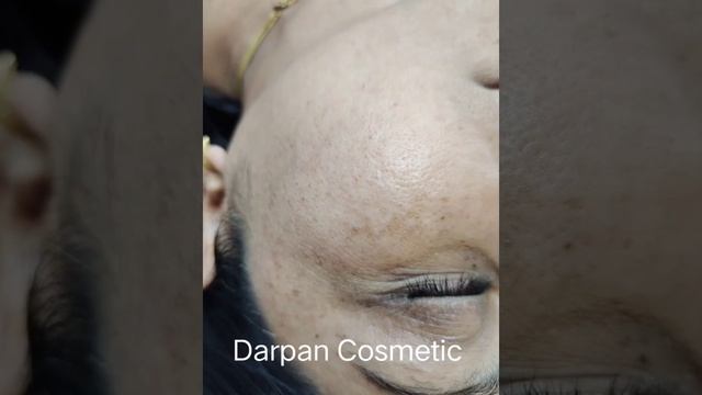 mole#skin tag removal #darpan cosmetic # смотреть онлайн