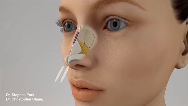 Улучшение носового дыхания - техника «Spreader graft» смотреть онлайн