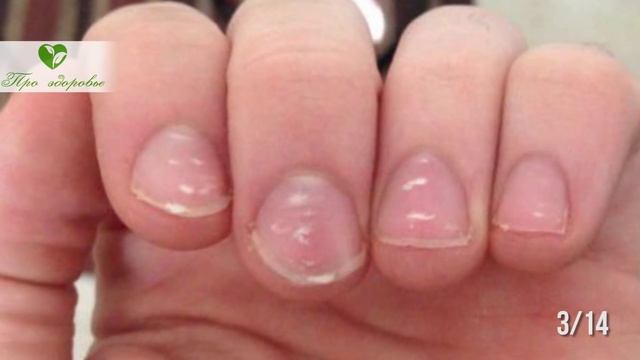 Мой доктор не мог поверить! Я сам поставил себе диагноз по виду ногтей смотреть онлайн
