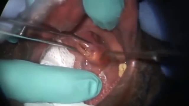 Удаление гнойных камней из миндалин