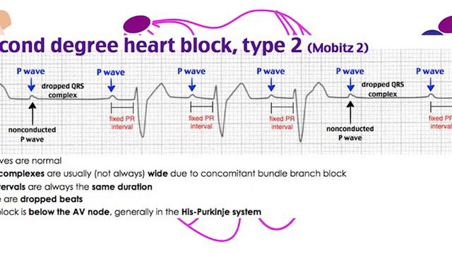 ЭКГ при АВ блокаде Анализ экг при ав блокаде 1 й, 2 й и 3 й степени смотреть онлайн