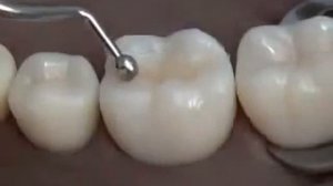 Препарирование по Блэку 1 класс