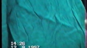 Кесарево  сечение № 11. Поперечное положение плода