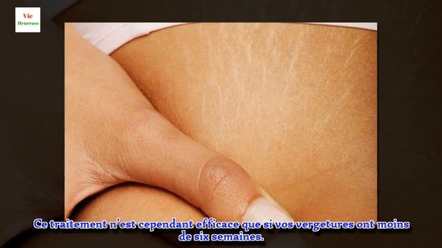 Comment se débarrasser des vergetures смотреть онлайн
