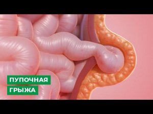 Пупочная грыжа