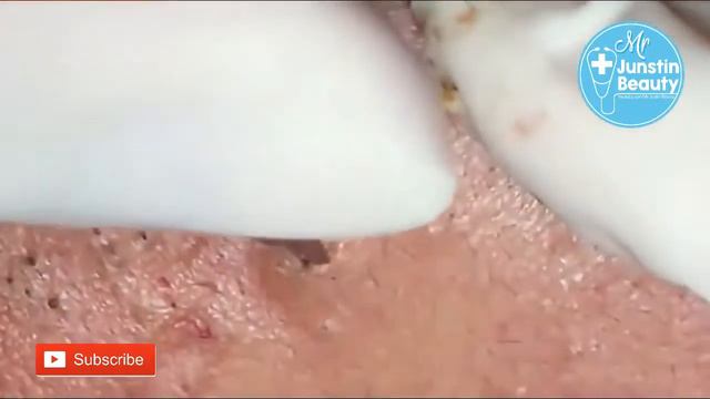 The getting rid of the acne blackheads on forehead - Acne Treatment Vlogs #Ep 41 смотреть онлайн