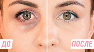 Как снять отек с глаз.Как убрать отеки под глазами.